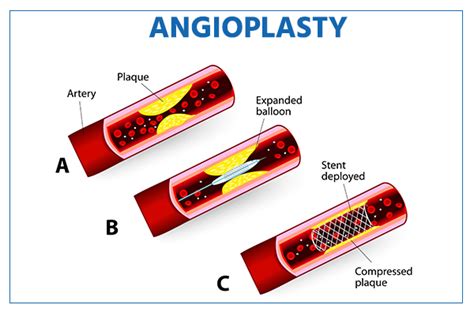 angioplasty surgery philippines